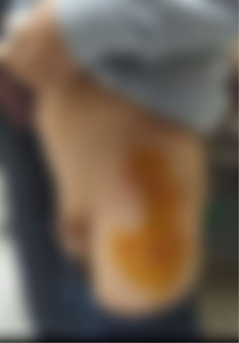 Kızıltepe’de sokak köpekleri 6 yaşındaki çocuğa saldırdı