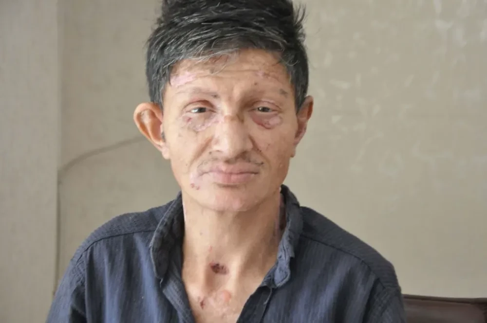 Bülloza hastası Ötünç: amacım sadece tedavi olmaktır