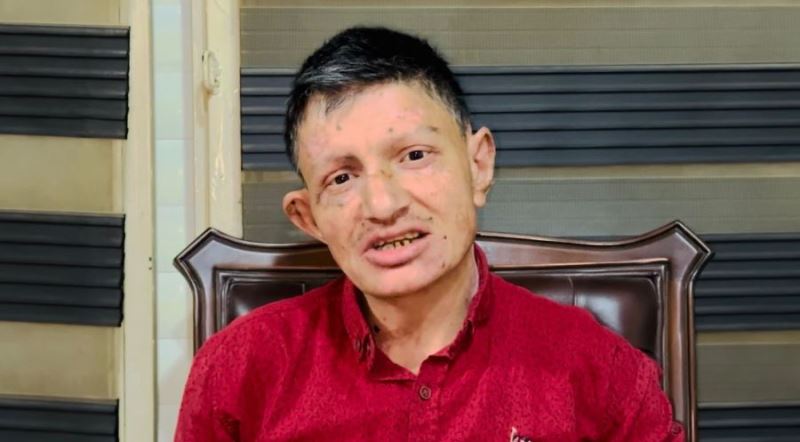 Vücudunda baloncuklar çıkıyor, hayatı kabusa dönüyor