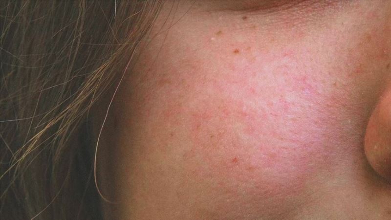 Gül hastalığı kadınlar ve açık tenlilerde daha çok görülüyor